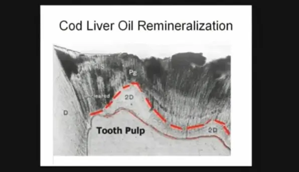 Slice of a decayed tooth